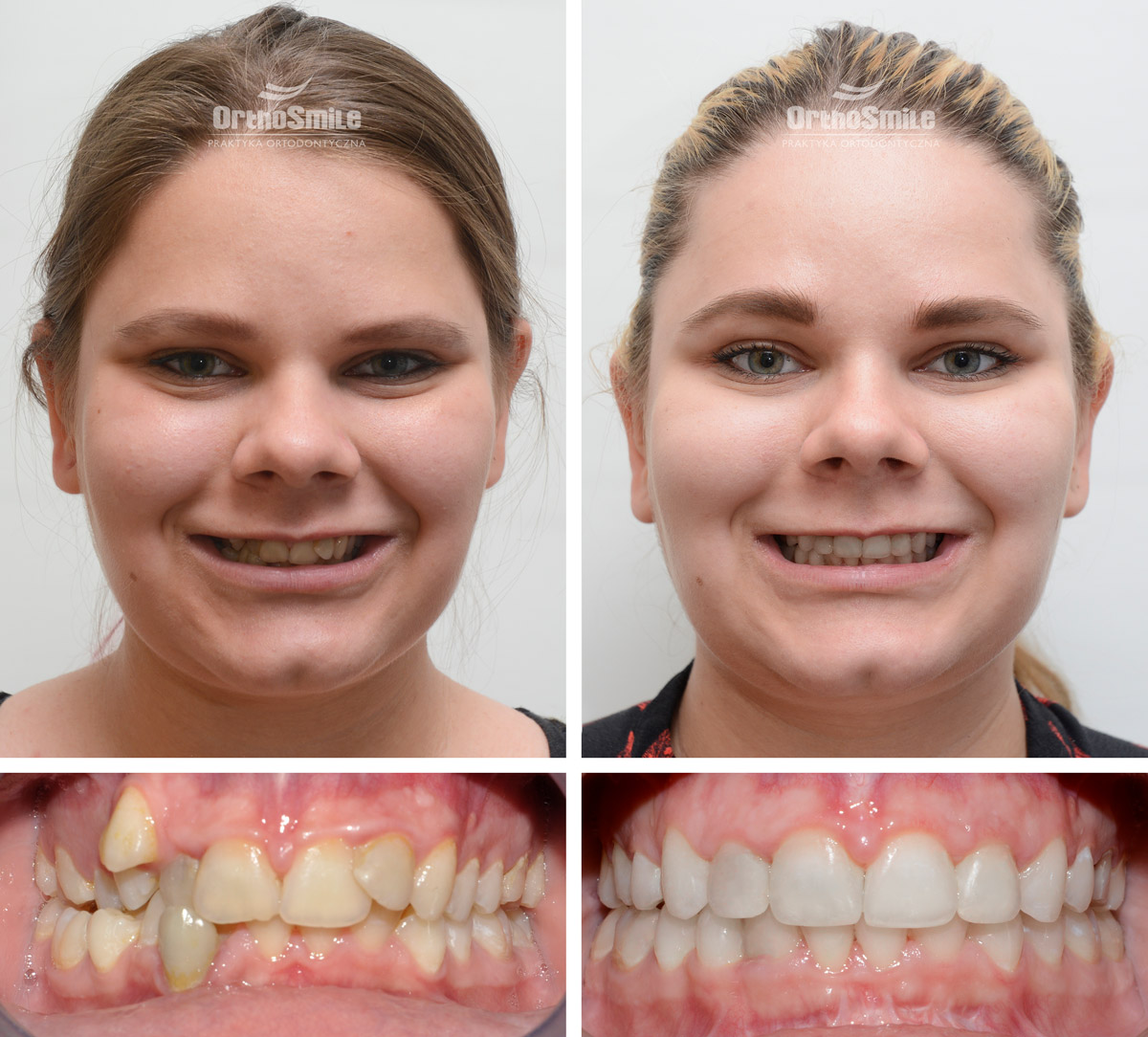#ortodoncja #ortodoncjawroclaw #operacjatwarzy #chirurgiatwarzy #wadazgryzu #pieknyusmiech #klinika #wroclaw #metamorfoza #orthosmile #smile